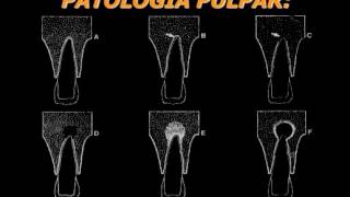 Aspectos Radiográficos de las Lesiones Apicales [upl. by Lavern85]