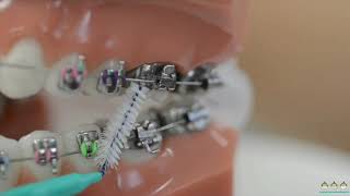 How to use interdental brushes on braces  Evolution Orthodontics [upl. by Eahcim]