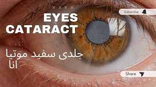 Early Age Cataract  Safaid Motiya Ka Jald Ana  Wajohat or Elaj  Eye Health Hub [upl. by Newell651]