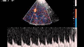 TRANSCRANIAL DOPPLER AND PARADOXICAL EMBOLISM [upl. by Custer140]