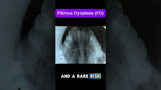 Fibrous Dysplasia FD [upl. by Ennyleuqcaj]