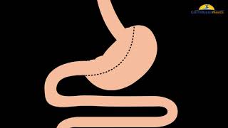 Cruce Duodenal con Gastric Bypass México [upl. by Meta]