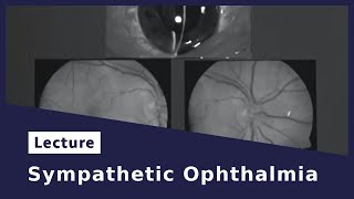 Sympathetic Ophthalmia [upl. by Nosyrb]