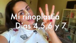 Mi rinoplastia día 45 6 y 7¡¡¡ ¿Que productos utilizo ¿Puedo respirar [upl. by Uda]