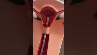 IUD  IUD Insertion  IUD procedure  3D animation  Shorts medical health iud [upl. by Inalan]