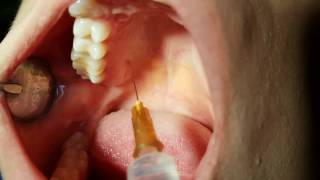 DENTAL ANESTHESIA TECHNIQUE  EXPLAINED [upl. by Ahcsap]