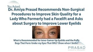 How Under Eye Wrinkles That Appear When Smiling can be Helped with NonSurgical Treatment [upl. by Albric]