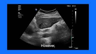 Gastroesophageal Junction ultrasound imaging Tips Challenges amp Clinical Importance [upl. by Mohammed]