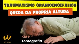 TCE TRAUMATISMO CRANIOENCEFÁLICO em Queda da Própria Altura visto na Tomografia de Crânio [upl. by Goldberg422]