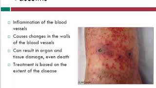 Vasculitis  Info About Vein Problems  WoundEducatorscom [upl. by Ebenezer]