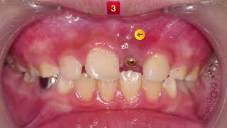 U1 Impaction Treatment｜【Chris Chang Ortho】CC813 [upl. by Reuven]