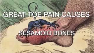 Dr Lakes Tips Great Toe Pain Causes  Sesamoid Bones [upl. by Lurette485]