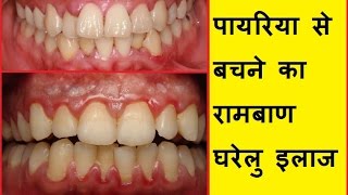 पायरिया के 3 प्रमुख कारण और इसके 12 रामबाण घरेलु इलाज How to get rid of Pyorrhea With Home remedies [upl. by Seen628]