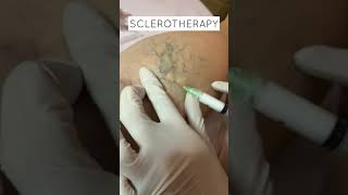 Foam sclerotherapy of spider veins shorts [upl. by Roosevelt]