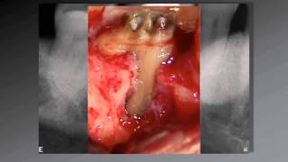 036 El uso de aumento en Endodoncia [upl. by Youlton]