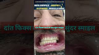 छोटे दांतों को बड़ा किया दांतों की लाइफ भी बड़ी और दी सुंदर मुस्कान smilemakeover with PFM crowns [upl. by Erusaert]