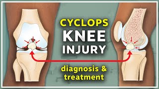 Cyclops injury of the knee Diagnosis and treatment [upl. by Asimaj]