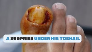 WHAT IS THIS SURPRISE UNDER HIS TOENAIL [upl. by Lettig]