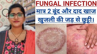 दाद खाज खुजली का जड़ से इलाज।।Fungus amp Tinea Treatment।।Ringworm Treatment।।khujli and daad ki dawa। [upl. by Netsua]