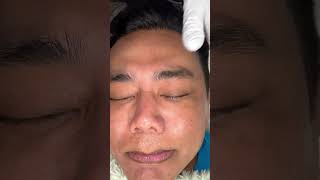 Fotona Laser Facial skincare fotonalaser fotona [upl. by Egiap]