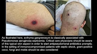 Ecthyma gangrenosum bei Pseudomonas aeruginosa Sepsis [upl. by Oicnoel]