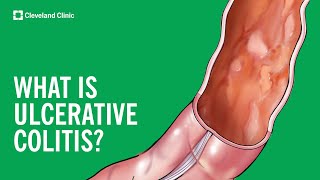 What Is Ulcerative Colitis [upl. by Anera]