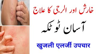 Jism ki kharish aur allergy khatam karne ka asan tarika  Skin allergy treatment at home  Khujli [upl. by Semaj447]