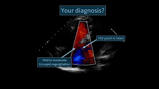 An echocardiographic case of a surgically treated Tetralogy of Fallot [upl. by Laikeze3]