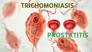 TRICHOMONIASIS ROLE IN PROSTATITIS [upl. by Stubbs]