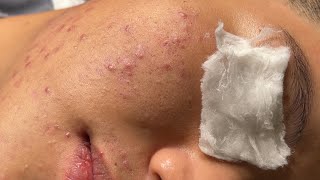 Blackheads amp Pimples Pore Removal New 2024  Acne Treatment With Bo Nguyễn Spa 027 [upl. by Eeclehc]