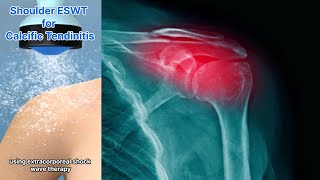 Calcific Tendinitis Of The Shoulder Extracorporeal Shock Wave Therapy May Be The Solution [upl. by Hirza]