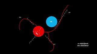 coronary Anomalous origin with anomalous course concepts [upl. by Ardath]