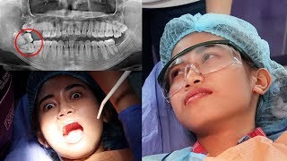 wisdom impacted teeth removal masakit ba [upl. by Hamner]