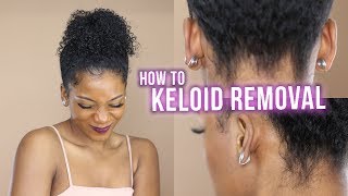 HOW I GOT RID OF MY KELOIDSLIVE INJECTIONS PROCEDURE  EARRINGS  EARLUMS CLIPS  Annesha Adams [upl. by Einad]