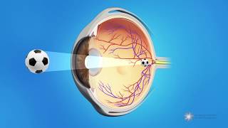 Posterior Capsule Opacification PCO  Also known as Secondary Cataracts or Cataract Scar Tissue [upl. by Ailiec658]