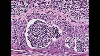 Histopathology SkinMycosis fungoides [upl. by Elyrrad]