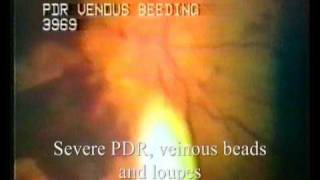 VideoDocumentation of Retinal Diseases [upl. by Gollin697]