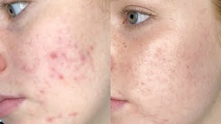 Spironolactone  Acne Review [upl. by Eitirahc920]