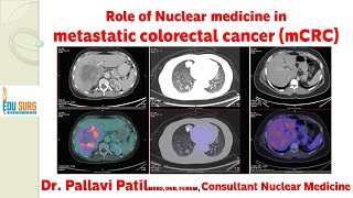 Role of PET scan Nuclear Medicine in the management of stage IV colon cancer and rectal cancer [upl. by Kyne]