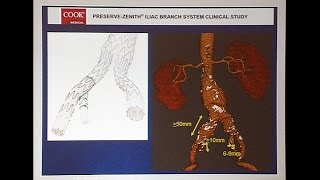 Hypogastric Artery Preservation When is it Necessary and HowIDoIt [upl. by Redleh418]