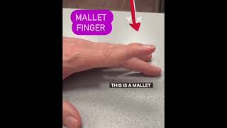 how to fix mallet finger injury mallets physio physicalfitness exercise rehab pain [upl. by Naehgem]