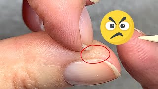 Hard Annoying Skin Around the Nails 2 Easy Solutions [upl. by Neenaej244]