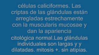 polipos intestinales1wmv [upl. by Gasser824]