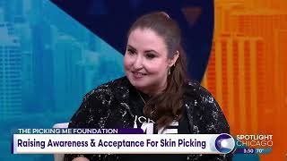 Spreading Skin Picking Awareness amp Education On The Local News [upl. by Zipah]