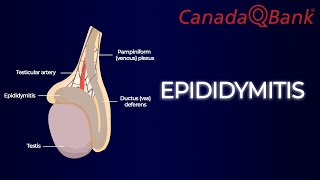 Epididymitis [upl. by Tsepmet]