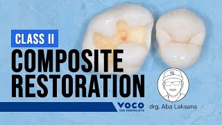 Posterior Restoration Class II Direct Composite Resin  Polofil Supra Microhybrid Composite VOCO [upl. by Phillips]