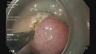 ESD for adenomatous gastric polyp [upl. by Yaral]