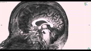 Whole Brain Cross Section MRI： 全脳断面 [upl. by Eseuqcaj653]