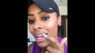 Adult Braces Vlog 6 Palate Expander Removal Dental Implants Snapchat Mariah Navit [upl. by Diver]