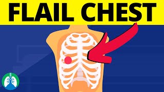 Flail Chest Medical Definition  Chest Trauma [upl. by Mable]